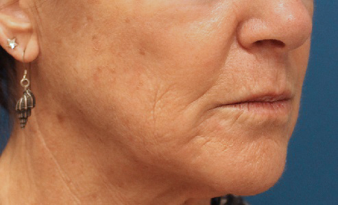 resurfacing laser skin fractional fractionated c02