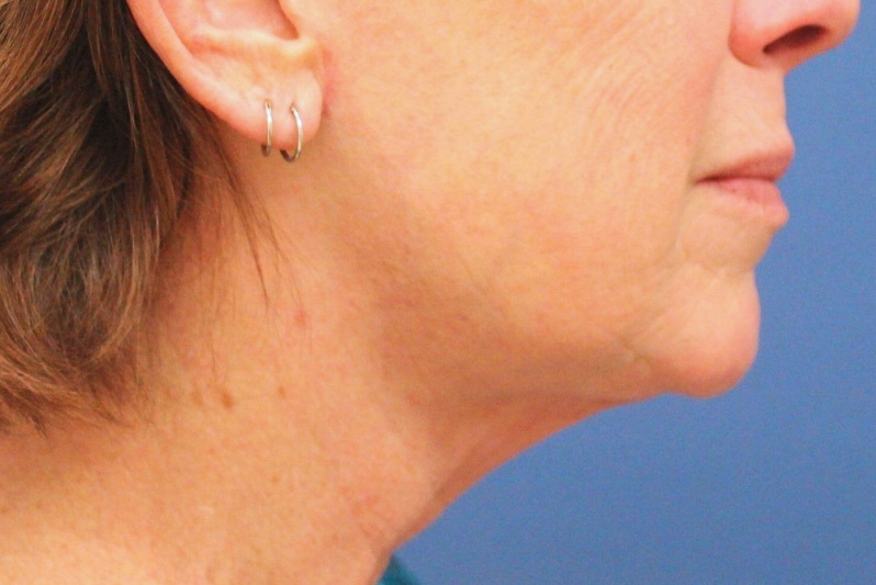 Chin Augmentation Case 4 - Cascade Facial Surgery and Aesthetics Mt. Vernon