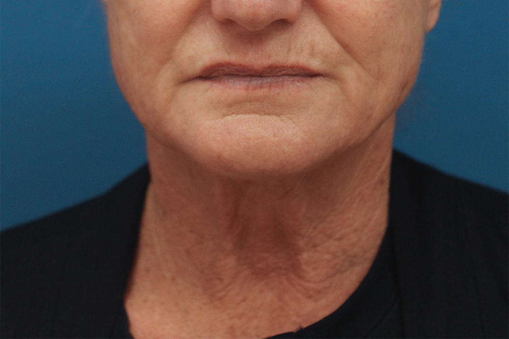 Face and Neck Lift Case 20 - Cascade Facial Surgery and Aesthetics Mt ...