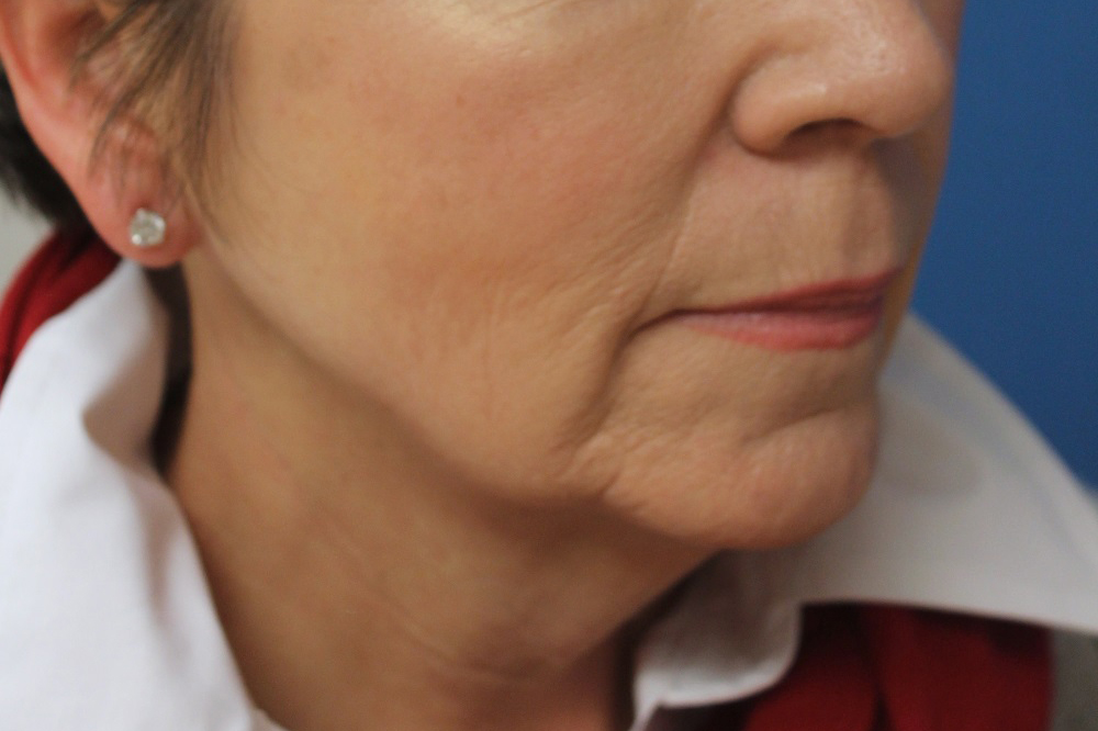 Face and Neck Lift Case 31 - Cascade Facial Surgery and Aesthetics Mt ...