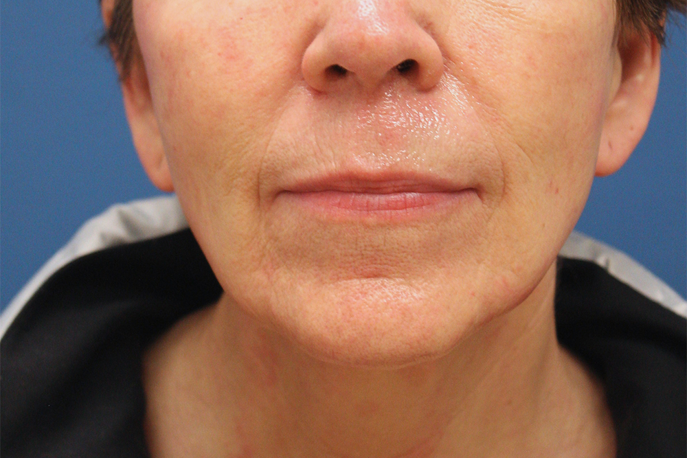Face and Neck Lift Case 31 - Cascade Facial Surgery and Aesthetics Mt ...