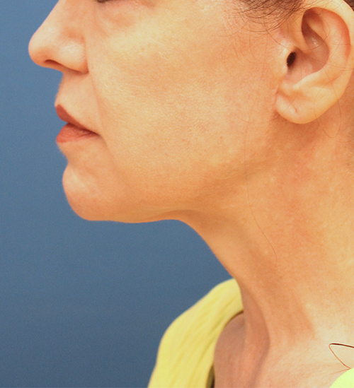 Cascade facial surgery 