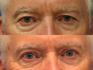 Before-and-after photo of actual blepharoplasty patient