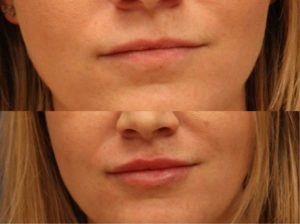 Before-and-after photo of actual dermal filler patient