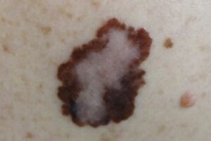 Skin Cancer Reconstruction for Marysville, WA patients