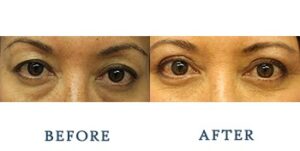 Eyelid Surgery Before and after patient photos for Marysville, WA patients