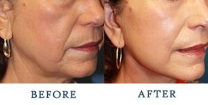 Facelift Before and after patient photos for Marysville, WA patients