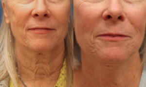 Neck Lift Before and after photos for Marysville, WA patients