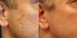 Laser Skin Resurfacing Before and after patient photos for Marysville, WA patients