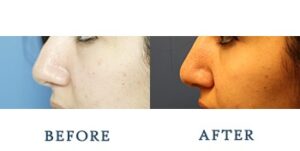 Rhinoplasty Before and after patient photos for Marysville, WA patients