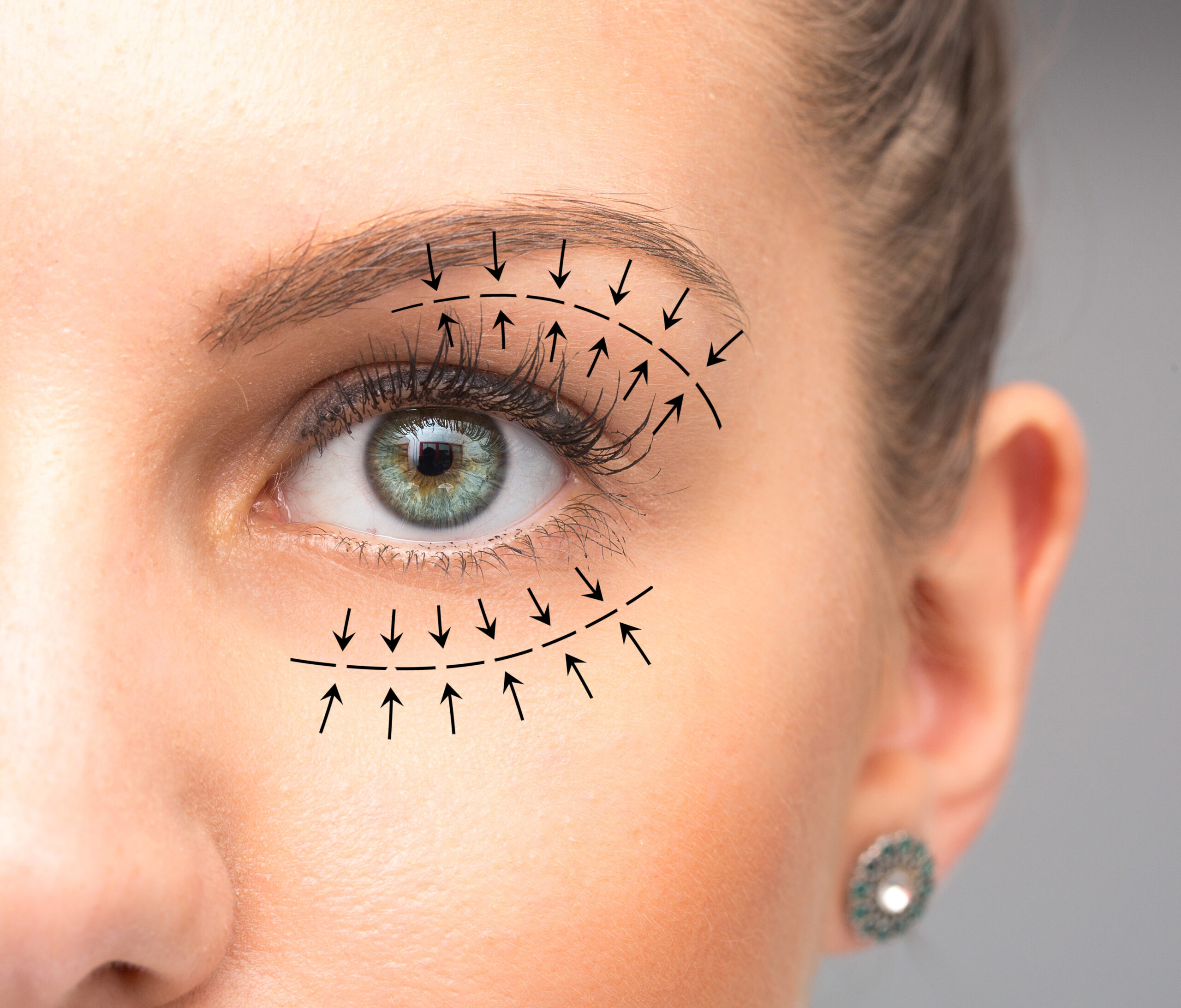 Eyelid surgery scars discount
