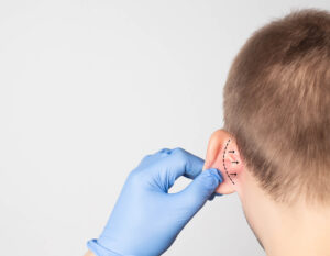 Ear Surgery FAQ for potential patients