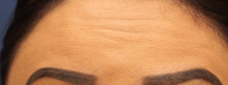 Botox Case 1 Cascade Facial Surgery And Aesthetics Mt Vernon