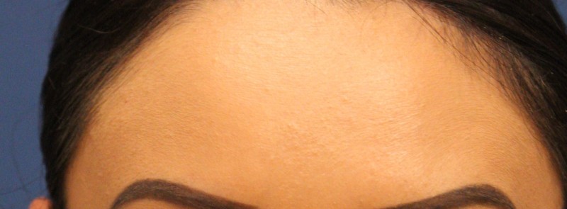 Botox Case 1 Cascade Facial Surgery And Aesthetics Mt Vernon