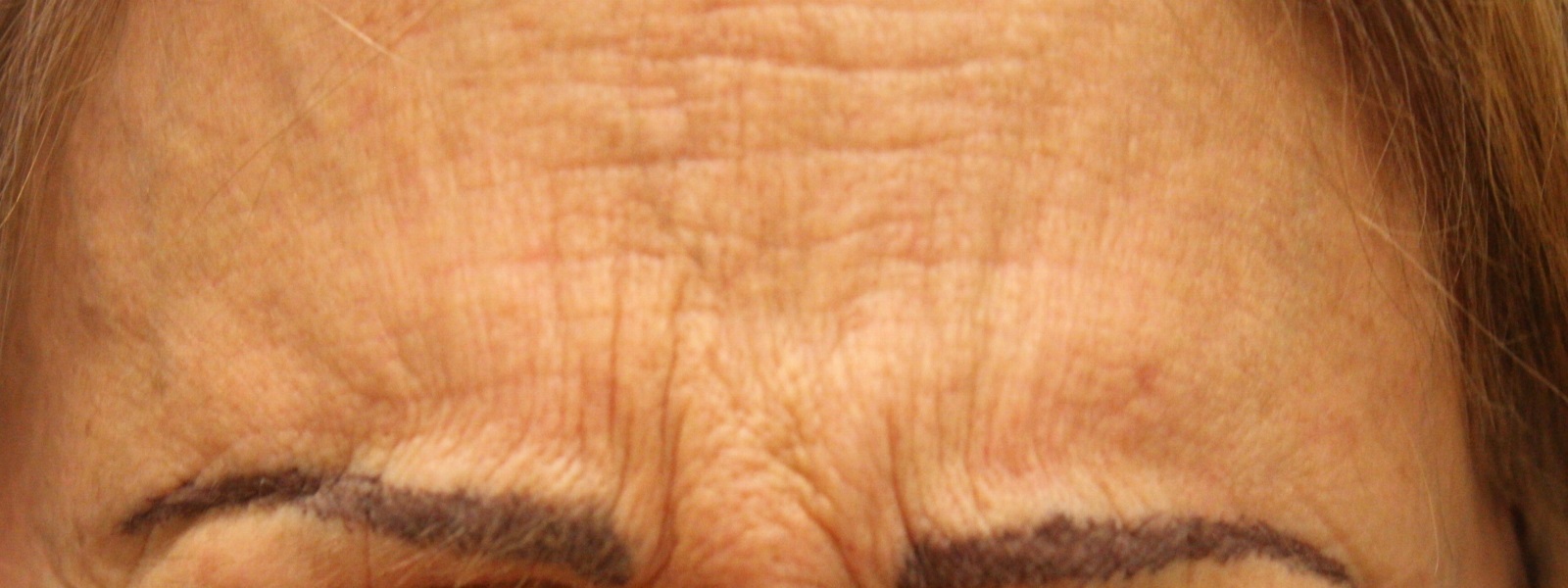 Botox Case 4 Cascade Facial Surgery And Aesthetics Mt Vernon