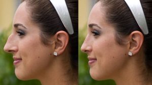 Woman pictured from the side, before and after rhinoplasty to correct appearance and breathing